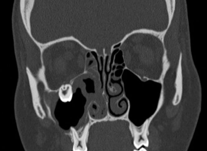 Coronal CT scan of the ectopic molar