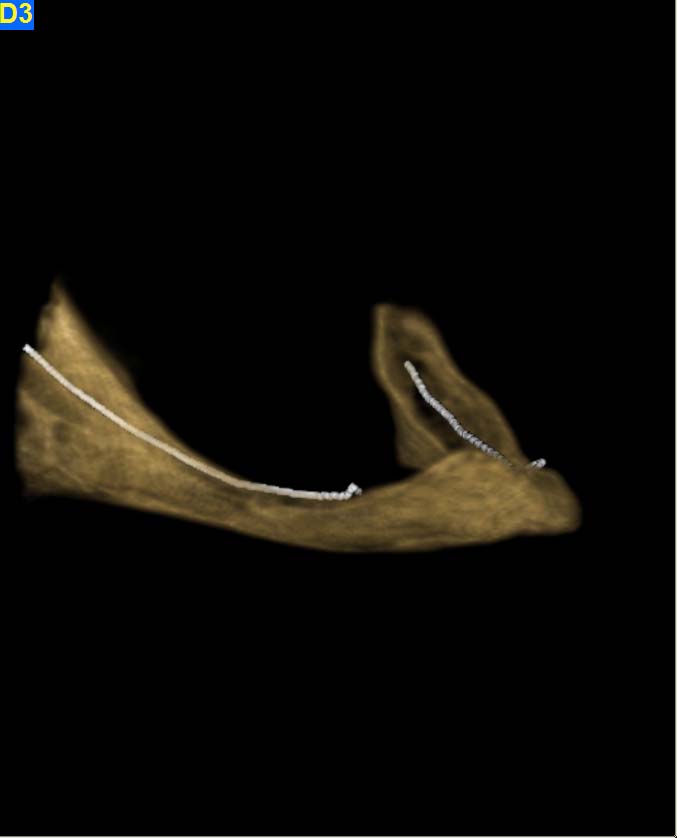 mandibular reconstructions